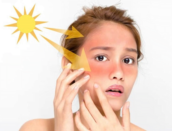 Ánh mặt trời gây nám da