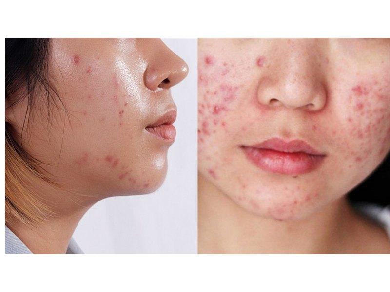 Da mụn khiến mọi người tự ti hơn