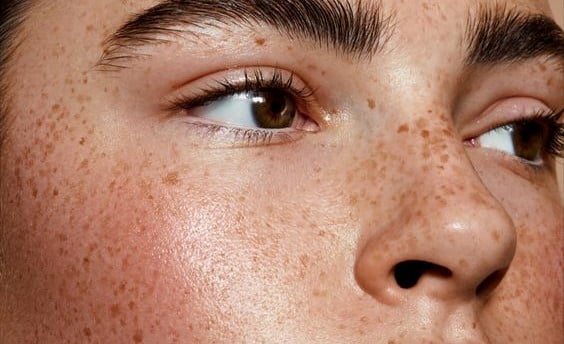 Mờ nám tàn nhang là một vấn đề mà nhiều người quan tâm