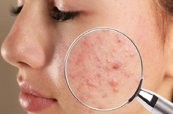 Không phải tất cả loại mụn đều có hiệu quả tốt