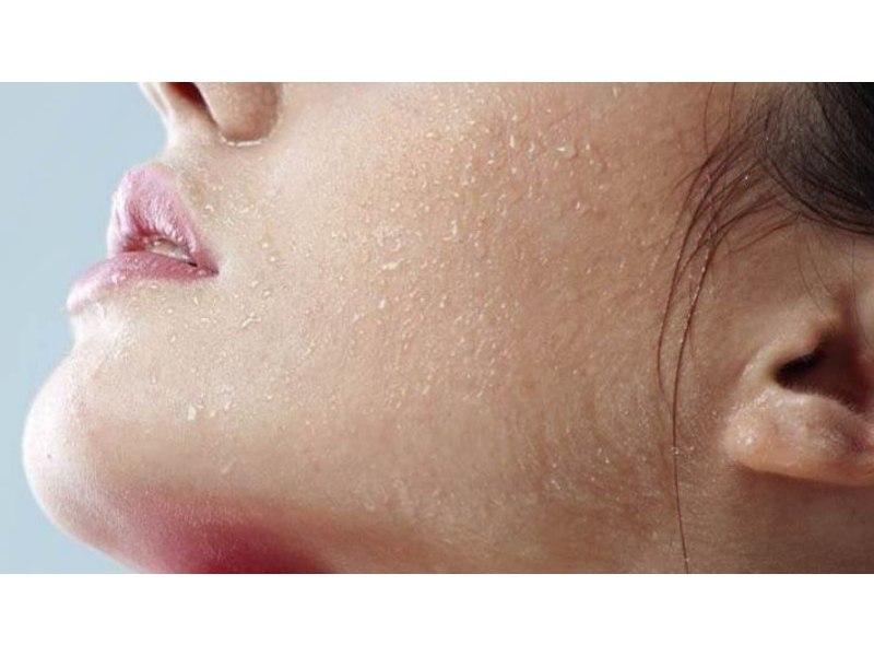 Làn da khô cần được cấp ẩm