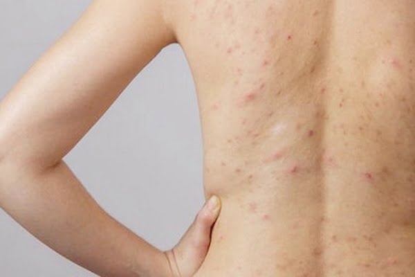 Các triệu chứng viêm lỗ chân lông