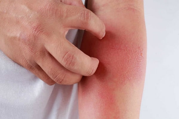 Mọi thức ăn đều có nguy cơ gây kích ứng