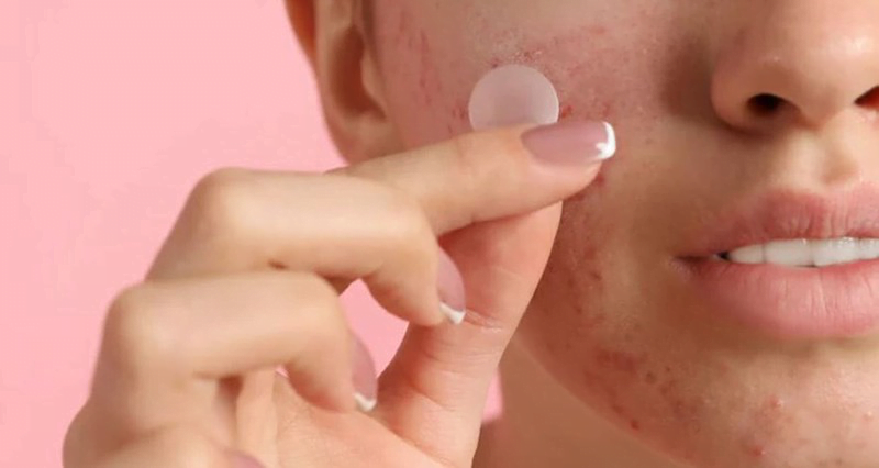 Cải thiện tình trạng mụn