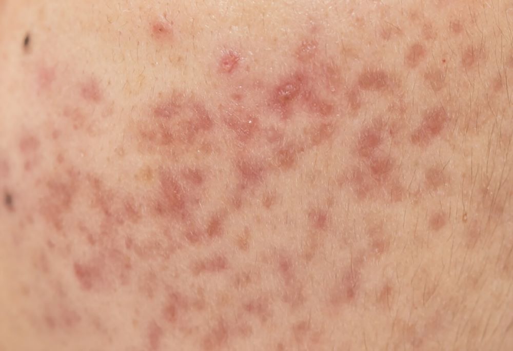 Sẹo thâm có tự hết không?