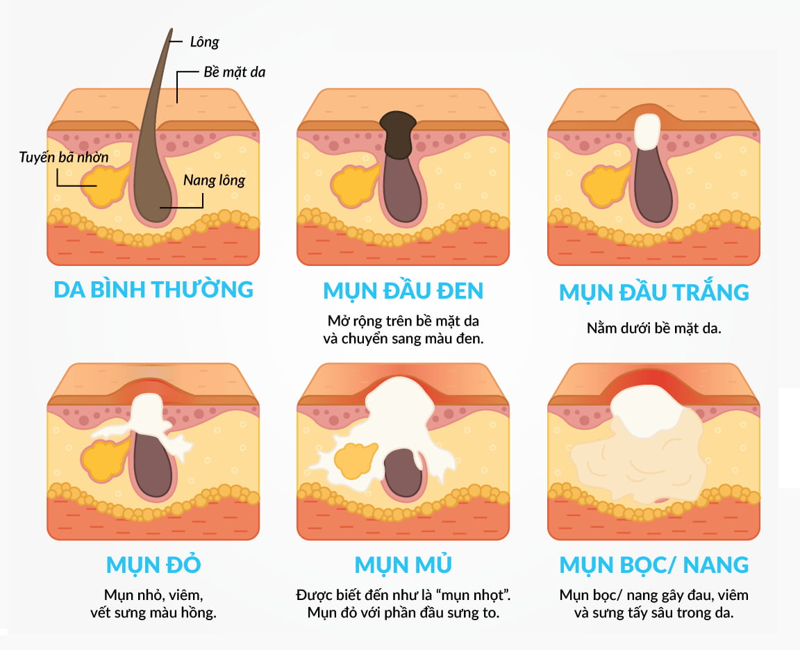 cách hết mụn đầu đen