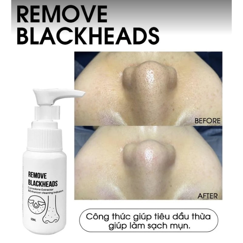 Tinh chất ủ mụn đầu đen ONmacabim