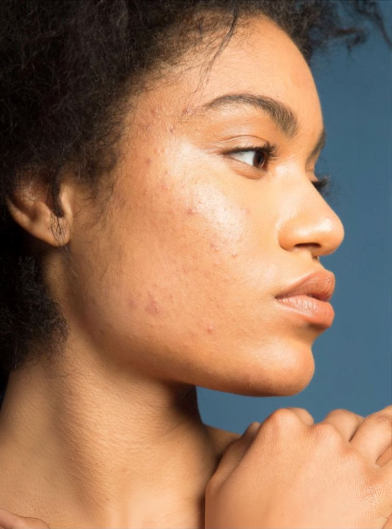 Da mụn cần chú ý hơn khi lựa chọn sản phẩm tẩy trang