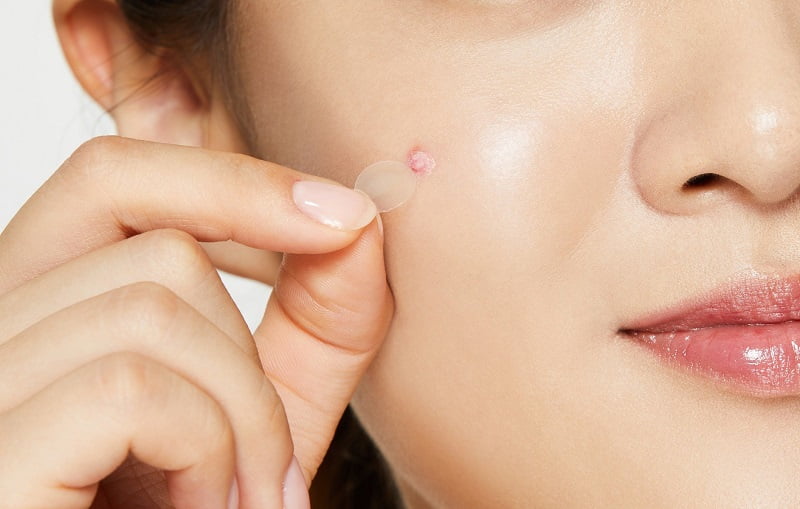 Miếng dán mụn và miếng dán microneedle có gì khác nhau?