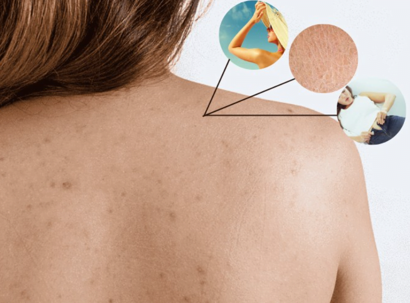 Các nguyên nhân dẫn đến thâm body là gì?